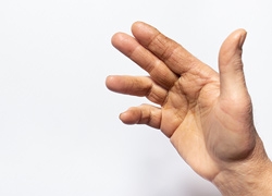 Nonsurgical Treatment Options for Dupuytren’s Contracture